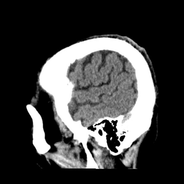File:Cerebellar hemorrhage (Radiopaedia 27193-27359 C 7).jpg