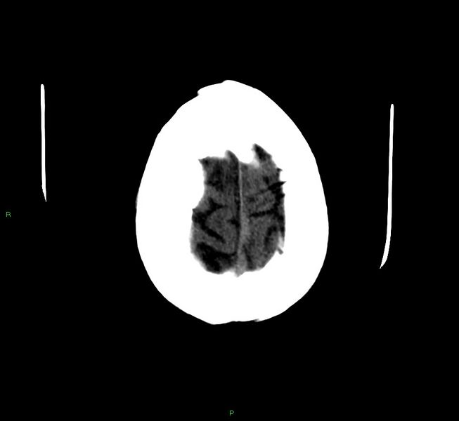 File:Cerebellar hemorrhage (Radiopaedia 58792-66026 Axial non-contrast 6).jpg