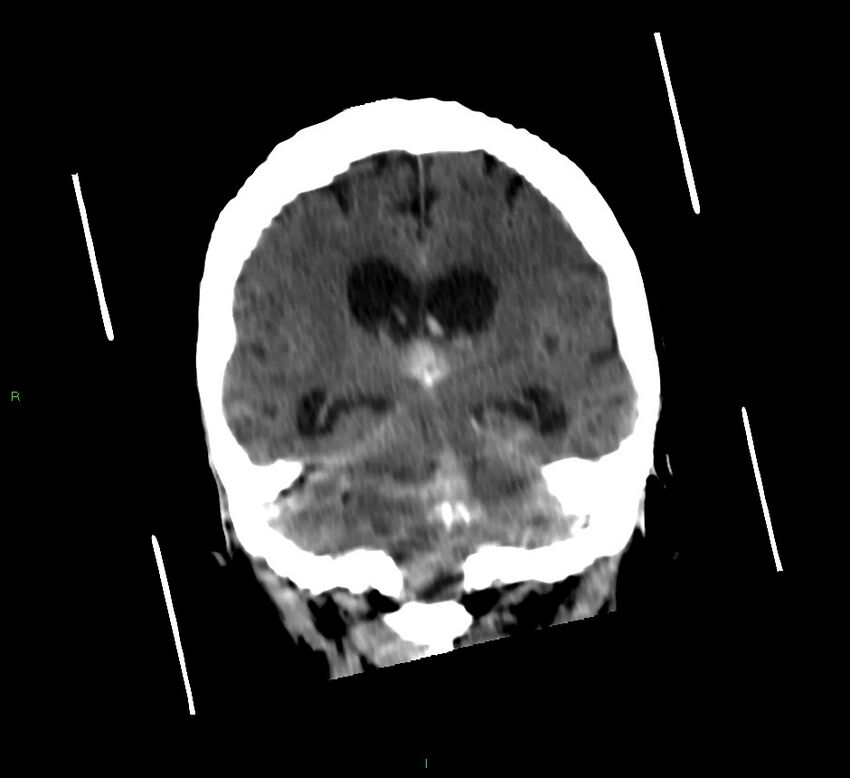 Cerebellar hemorrhage (Radiopaedia 58792-66026 Coronal non-contrast 29).jpg