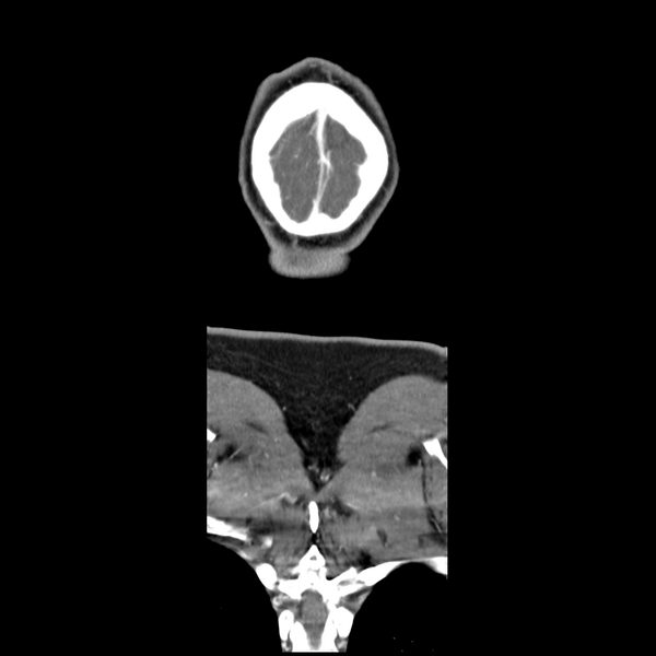 File:Cerebellar infarct due to vertebral artery dissection with posterior fossa decompression (Radiopaedia 82779-97029 D 64).png