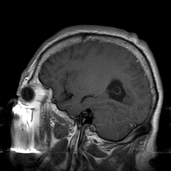 File:Cerebellopontine angle meningioma (Radiopaedia 24459-24764 Sagittal T1 C+ 19).jpg