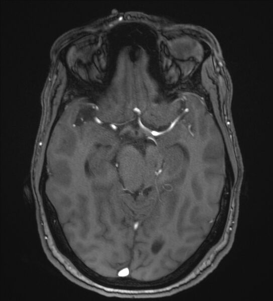File:Cerebellopontine angle meningioma (Radiopaedia 72983-83680 Axial MRA 50).jpg