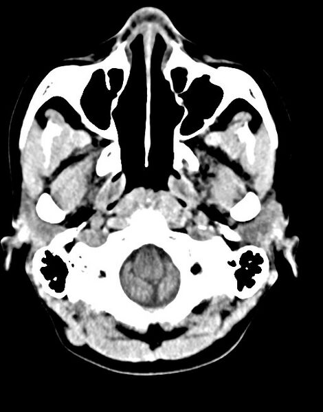 File:Cerebral abscesses (Radiopaedia 70458-80568 Axial non-contrast 12).jpg