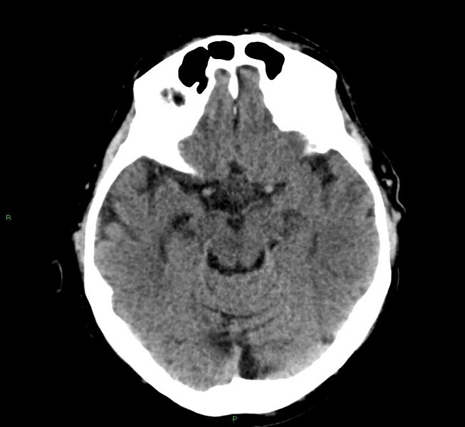 File:Cerebral amyloid angiopathy-associated lobar intracerebral hemorrhage (Radiopaedia 58376-65511 Axial non-contrast 36).jpg