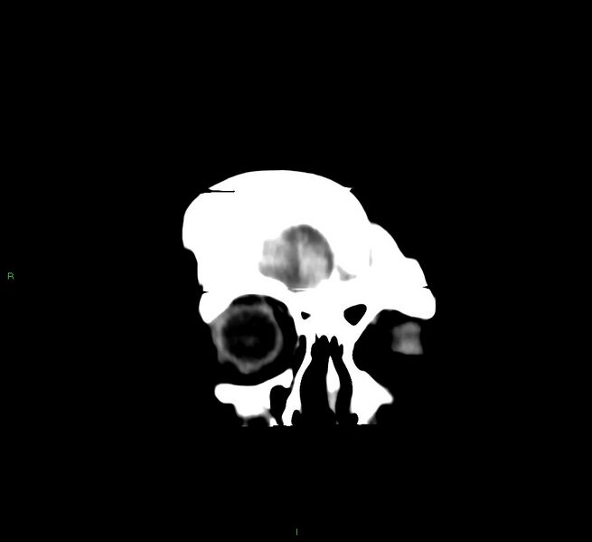 File:Cerebral amyloid angiopathy-associated lobar intracerebral hemorrhage (Radiopaedia 58377-65514 Coronal non-contrast 60).jpg