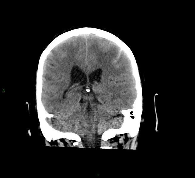 File:Cerebral amyloid angiopathy-associated lobar intracerebral hemorrhage (Radiopaedia 58529-65681 Coronal non-contrast 27).jpg