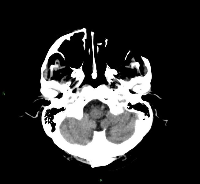 File:Cerebral amyloid angiopathy-associated lobar intracerebral hemorrhage (Radiopaedia 58530-65688 Axial non-contrast 43).jpg