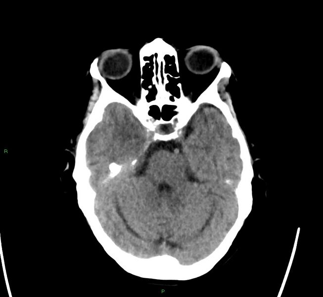 File:Cerebral amyloid angiopathy-associated lobar intracerebral hemorrhage (Radiopaedia 58563-65727 Axial non-contrast 38).jpg