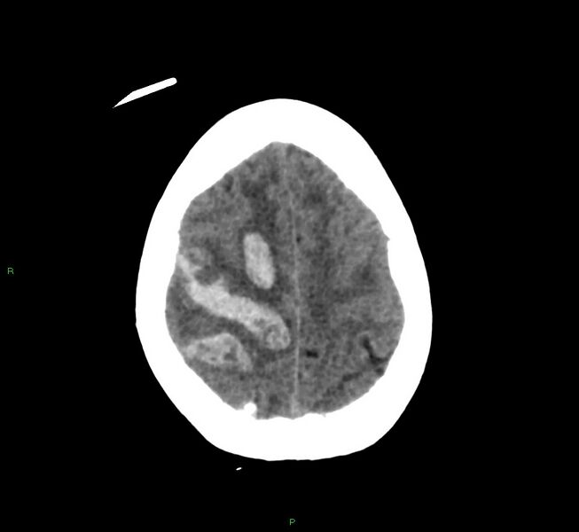 File:Cerebral amyloid angiopathy-associated lobar intracerebral hemorrhage (Radiopaedia 58566-65730 Axial non-contrast 11).jpg