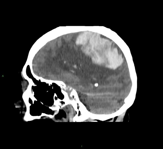 File:Cerebral amyloid angiopathy-associated lobar intracerebral hemorrhage (Radiopaedia 58751-65972 C 24).jpg