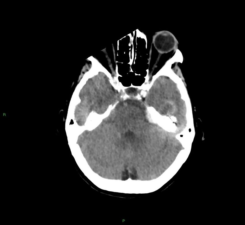 Cerebral amyloid angiopathy-associated lobar intracerebral hemorrhage (Radiopaedia 58754-65975 Axial non-contrast 43).jpg
