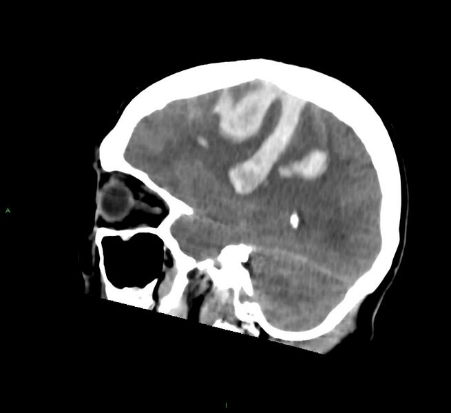 File:Cerebral amyloid angiopathy-associated lobar intracerebral hemorrhage (Radiopaedia 58756-65977 C 21).jpg