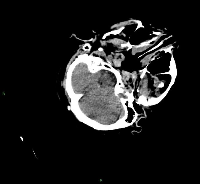 File:Cerebral amyloid angiopathy-associated lobar intracerebral hemorrhage (Radiopaedia 58757-65979 Axial non-contrast 28).jpg