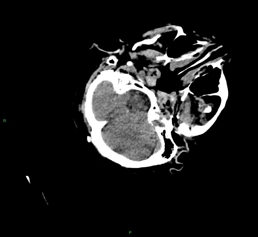 Cerebral amyloid angiopathy-associated lobar intracerebral hemorrhage (Radiopaedia 58757-65979 Axial non-contrast 28).jpg