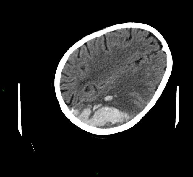 File:Cerebral amyloid angiopathy-associated lobar intracerebral hemorrhage (Radiopaedia 58757-65979 Axial non-contrast 92).jpg