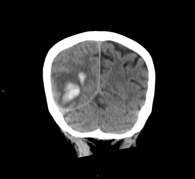 File:Cerebral amyloid angiopathy-associated lobar intracerebral hemorrhage (Radiopaedia 58758-65980 Coronal non-contrast 18).jpg