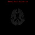 Cerebral and orbital tuberculomas (Radiopaedia 13308-13311 Axial DWI 12).jpg