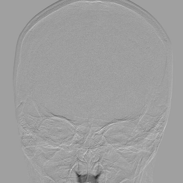 File:Cerebral aneurysm with rupture (Radiopaedia 29933-30458 LT CCA IC 5).jpg