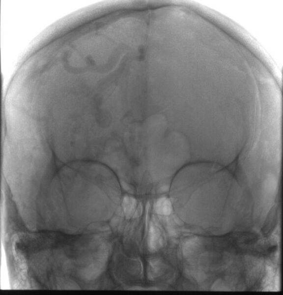 File:Cerebral arteriovenous malformation (Radiopaedia 10989-11408 F 1).jpg