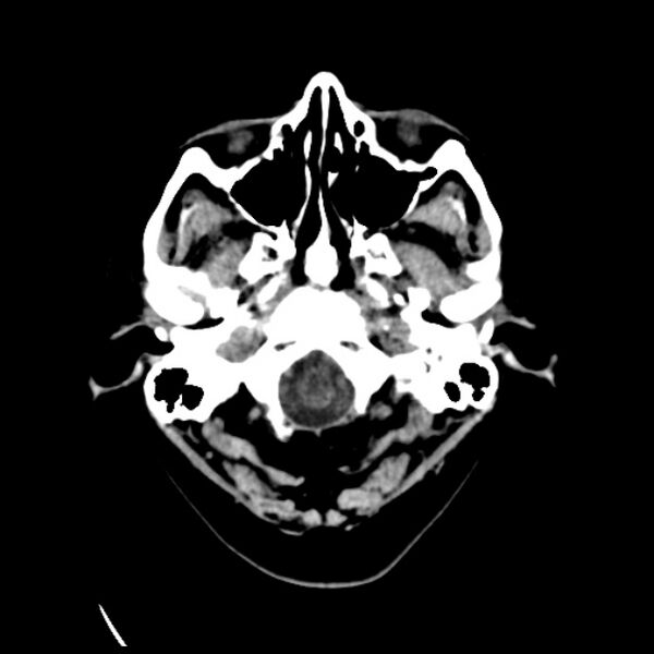 File:Cerebral arteriovenous malformation (Radiopaedia 43729-47189 Axial non-contrast 1).jpg