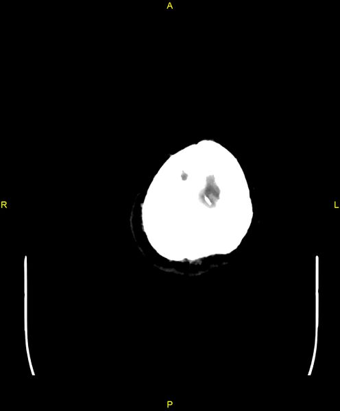 File:Cerebral autosomal dominant arteriopathy with subcortical infarcts and leukoencephalopathy (CADASIL) (Radiopaedia 86108-102051 Axial non-contrast 113).jpg