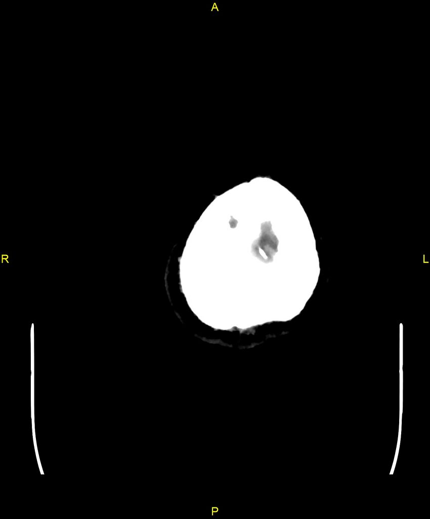 Cerebral autosomal dominant arteriopathy with subcortical infarcts and leukoencephalopathy (CADASIL) (Radiopaedia 86108-102051 Axial non-contrast 113).jpg