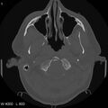 Cerebral hemorrhagic contusion with subdural and subarachnoid hemorrhage (Radiopaedia 10680-11146 Axial bone window 1).jpg