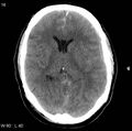 Cerebral hemorrhagic contusion with subdural and subarachnoid hemorrhage (Radiopaedia 10680-11146 Axial non-contrast 13).jpg