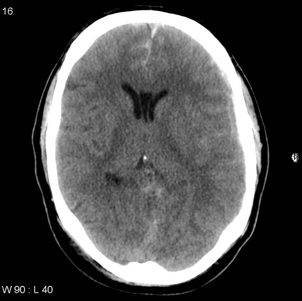 File:Cerebral hemorrhagic contusion with subdural and subarachnoid hemorrhage (Radiopaedia 10680-11146 Axial non-contrast 13).jpg
