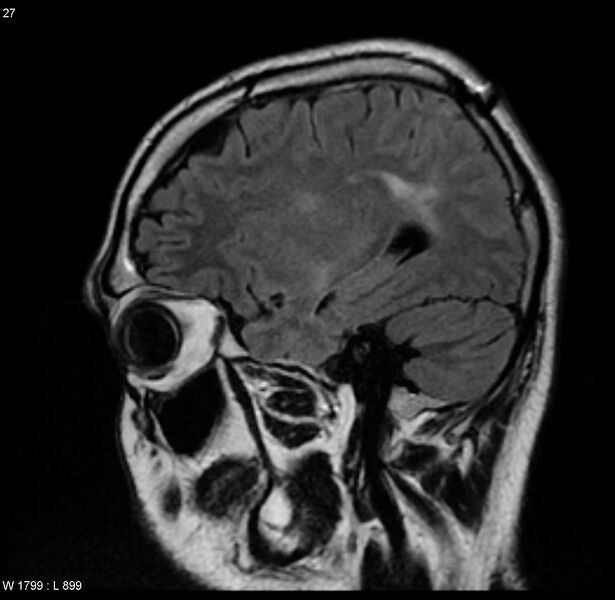 File:Cerebral vasculitis (Radiopaedia 5131-6923 Sagittal FLAIR 10).jpg