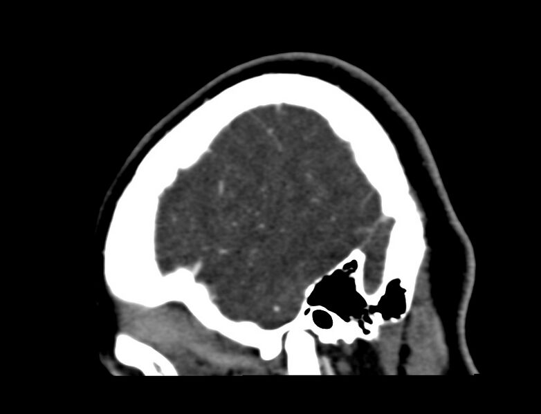 File:Cerebral venous sinus thrombosis (Radiopaedia 59224-66646 Sagittal C+ delayed 62).jpg