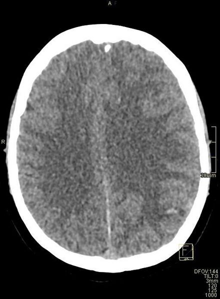File:Cerebral venous sinus thrombosis (Radiopaedia 91329-108965 Axial non-contrast 33).jpg