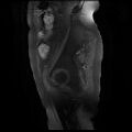Cervical carcinoma (Radiopaedia 78847-91705 Sagittal T1 fat sat 16).jpg