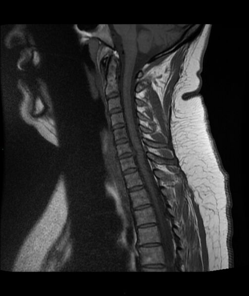 File:Cervical disc prolapse (Radiopaedia 80258-93598 Sagittal T1 8).jpg