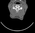 Cervical dural CSF leak on MRI and CT treated by blood patch (Radiopaedia 49748-54996 B 29).png