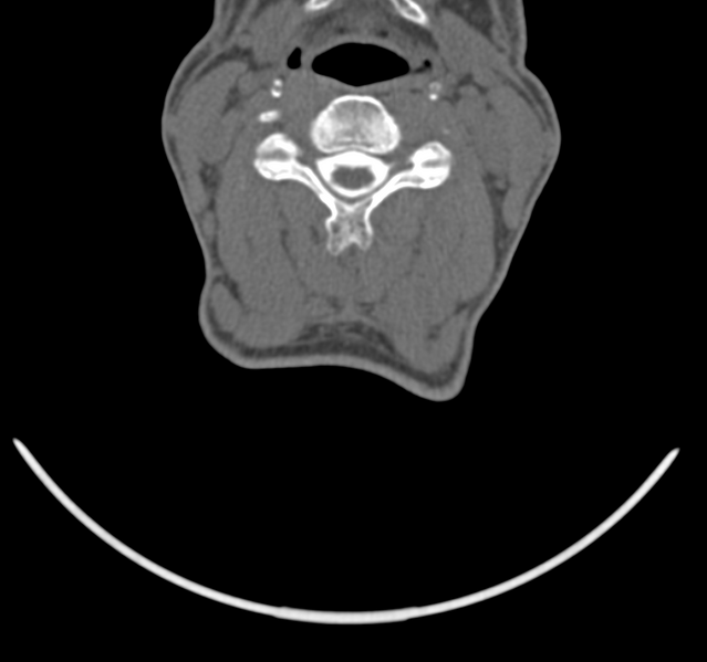 File:Cervical dural CSF leak on MRI and CT treated by blood patch (Radiopaedia 49748-54996 B 29).png