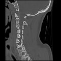 Cervical flexion teardrop fracture with cord hemorrhage (Radiopaedia 32497-33454 Sagittal bone window 17).jpg