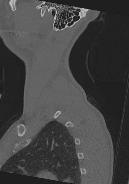 File:Cervical intercalary bone (Radiopaedia 35211-36748 Sagittal bone window 4).png