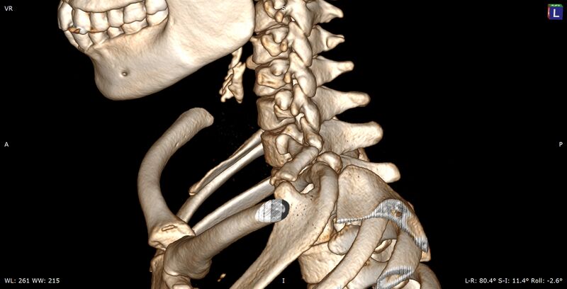 File:Cervical rib (Radiopaedia 71110-81364 Sagittal 3D VR 1).jpg