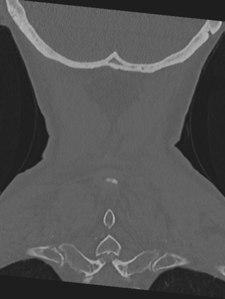 File:Cervical spondylolysis (Radiopaedia 49616-54811 Coronal bone window 54).png