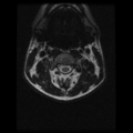 Cervical vertebrae metastasis (Radiopaedia 78814-91667 Axial T2 17).png