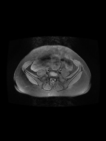 File:Cesarean section scar endometrioma (Radiopaedia 56569-63297 Axial PD fat sat 7).jpg