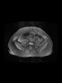 Cesarean section scar endometrioma (Radiopaedia 56569-63297 Axial PD fat sat 7).jpg