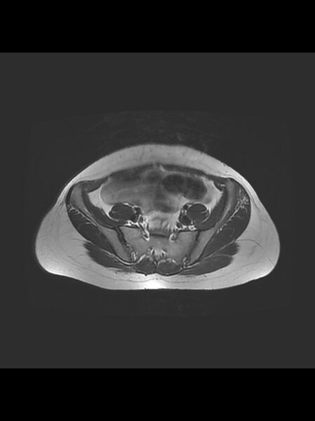 File:Cesarean section scar endometrioma (Radiopaedia 56569-63297 Axial T2 5).jpg