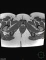 Cesarian scar endometriosis (Radiopaedia 68495-78066 Axial T1 25).jpg