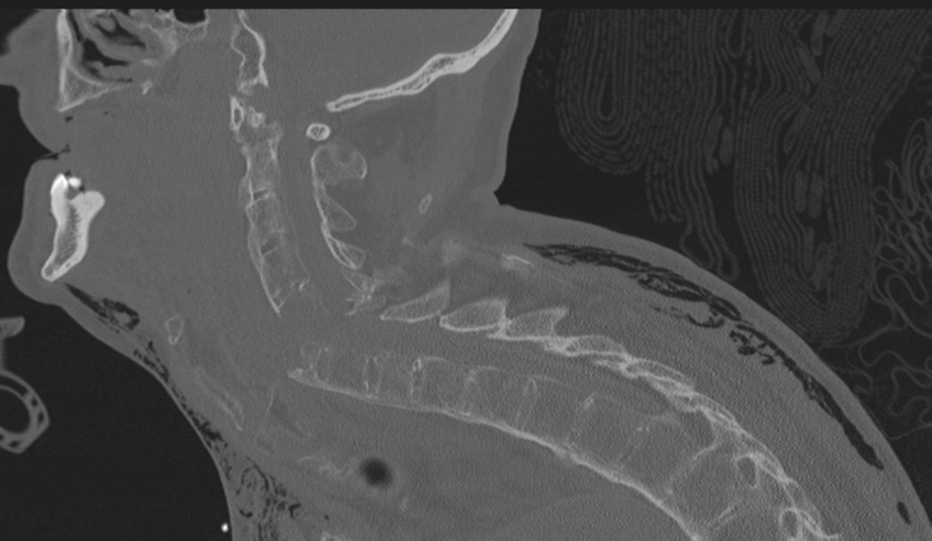 Chalk stick fracture (Radiopaedia 57948-64928 Sagittal bone window 27).png