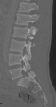 Chance fracture (Radiopaedia 40360-42912 Sagittal bone window 42).png