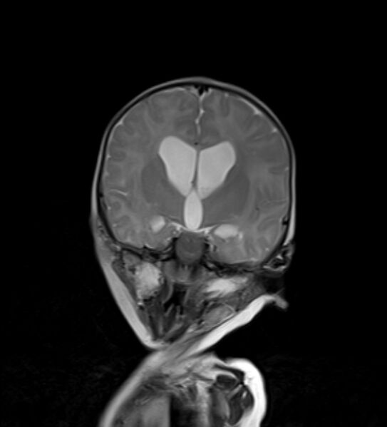 File:Chiari III malformation with occipital encephalocele (Radiopaedia 79446-92559 Coronal T2 23).jpg