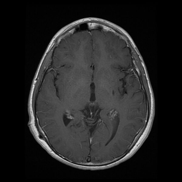 File:Chiasmatic-hypothalamic juvenile pilocytic astrocytoma (Radiopaedia 78533-91236 Axial T1 C+ 15).jpg
