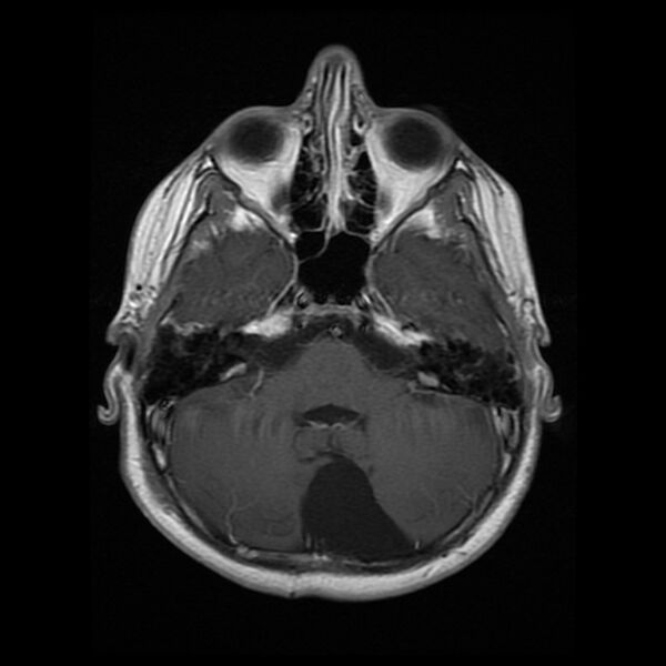 File:Chiasmatic-hypothalamic juvenile pilocytic astrocytoma (Radiopaedia 78533-91236 Axial T1 C+ 9).jpg